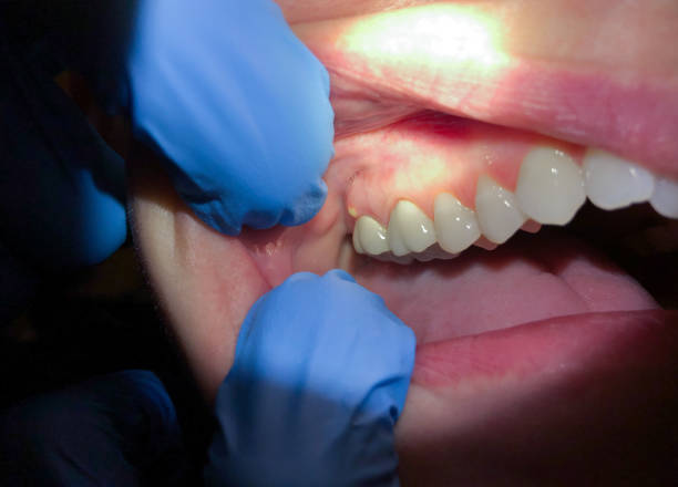 Best Root Canal Emergency Dentist  in Red Hill, PA